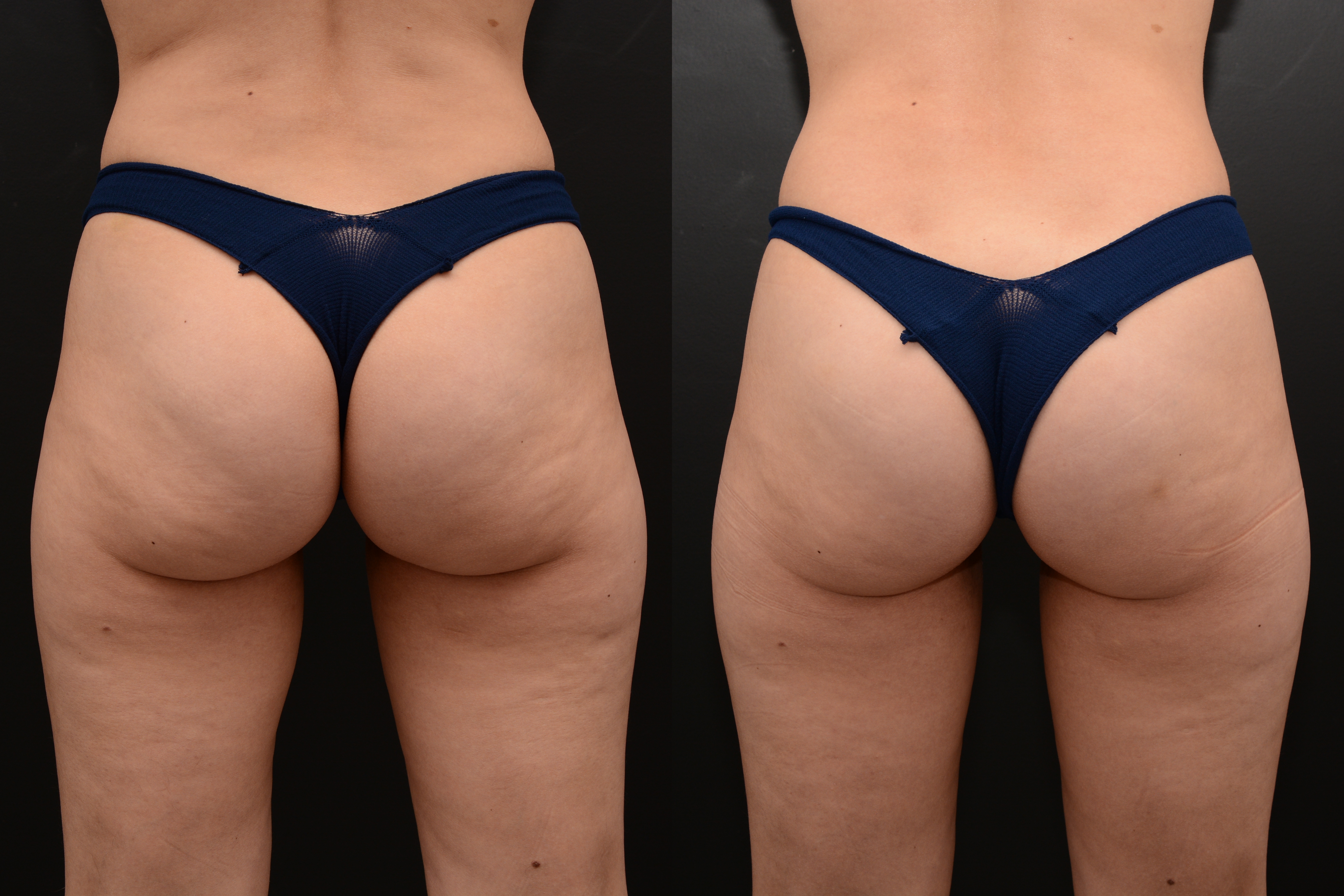 Emsculpt buttocks enhancement after 4 treatments - before and after